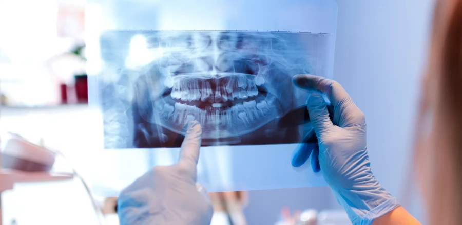 dents impactees la native